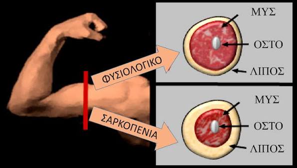 Σαρκοπενία: Αιτίες απώλειας μυϊκής μάζας και λύσεις
